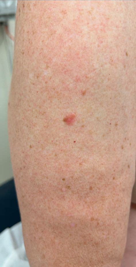 skin cancer spots on arm